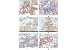 Immunohistochemical analysis of paraffin-embedded human breast intraductal carcinama tissues (A) and breast infiltrating ductal carcinama tissues (B) showing membrane localization using ERBB2 mouse mAb with DAB staining.