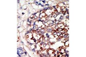 Formalin-fixed and paraffin-embedded human cancer tissue reacted with the primary antibody, which was peroxidase-conjugated to the secondary antibody, followed by DAB staining. (DYRK1B antibody  (C-Term))