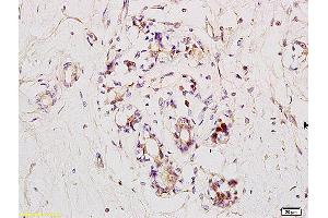 Formalin-fixed and paraffin embedded human breast carcinoma labeled with Anti RNF31/HOIP Polyclonal Antibody, Unconjugated (ABIN1387804) at 1:200 followed by conjugation to the secondary antibody and DAB staining. (RNF31 antibody)
