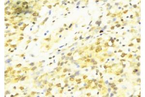 ABIN6273437 at 1/100 staining Human breast cancer tissue by IHC-P.