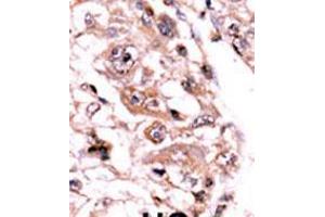 Formalin-fixed and paraffin-embedded human cancer tissue reacted with the primary antibody, which was peroxidase-conjugated to the secondary antibody, followed by AEC staining. (PPP3CC antibody  (C-Term))
