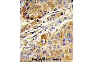 Formalin-fixed and paraffin-embedded human hepatocarcinoma reacted with MASTL Antibody, which was peroxidase-conjugated to the secondary antibody, followed by DAB staining. (MASTL antibody)