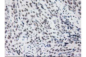 Immunohistochemical staining of paraffin-embedded Adenocarcinoma of Human breast tissue using anti-MGLL mouse monoclonal antibody. (MGLL antibody)