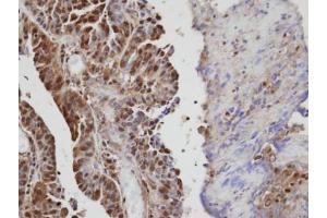 IHC-P Image Immunohistochemical analysis of paraffin-embedded human serous ovarian cancer, using VAV1, antibody at 1:100 dilution.
