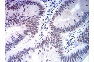 Immunohistochemical analysis of paraffin-embedded rectum cancer tissues using MSH2 mouse mAb with DAB staining. (MSH2 antibody  (AA 442-586))