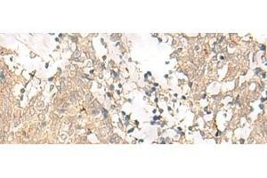 Immunohistochemistry of paraffin-embedded Human lung cancer tissue using GPSM1 Polyclonal Antibody at dilution of 1:85(x200) (GPSM1 antibody)