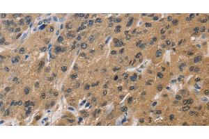 Immunohistochemistry of paraffin-embedded Human liver cancer tissue using DUSP26 Polyclonal Antibody at dilution 1:60 (DUSP26 antibody)