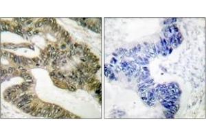 Immunohistochemistry analysis of paraffin-embedded human colon carcinoma tissue, using APC Antibody. (APC antibody  (AA 2794-2843))