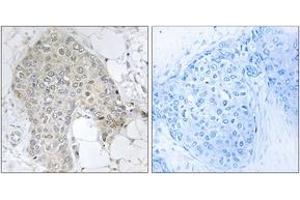 Immunohistochemistry analysis of paraffin-embedded human breast carcinoma tissue, using PPP1R2 (Ab-120/121) Antibody. (PPP1R2 antibody  (AA 86-135))