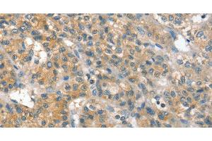 Immunohistochemistry of paraffin-embedded Human liver cancer using PPP2CA Polyclonal Antibody at dilution of 1:35 (PPP2CA antibody)