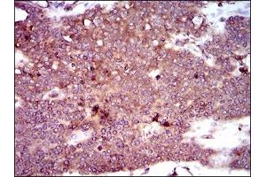Immunohistochemical analysis of paraffin-embedded ovarian cancer tissues using DCTN4 mouse mAb with DAB staining.