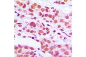 Immunohistochemical analysis of Histone H3 (pS10) staining in human breast cancer formalin fixed paraffin embedded tissue section. (Histone 3 antibody  (pSer10))