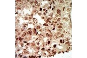 Formalin-fixed and paraffin-embedded human cancer tissue reacted with the primary antibody, which was peroxidase-conjugated to the secondary antibody, followed by AEC staining. (MAPK11 antibody  (AA 334-366))