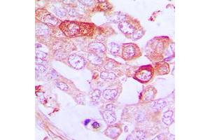 Immunohistochemical analysis of A20 staining in human lung cancer formalin fixed paraffin embedded tissue section. (IGKV1-27 antibody  (Center))