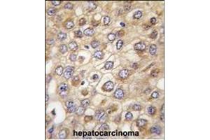 Formalin-fixed and paraffin-embedded human hepatocarcinoma tissue reacted with CLDN2 (Human N-term) (ABIN390291 and ABIN2840730) , which was peroxidase-conjugated to the secondary antibody, followed by DAB staining. (Claudin 2 antibody  (N-Term))