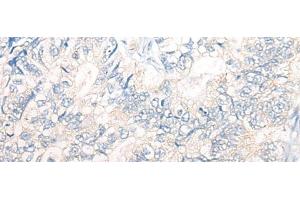 Immunohistochemistry of paraffin-embedded Human gastric cancer tissue using PNPO Polyclonal Antibody at dilution of 1:30(x200) (PNPO antibody)