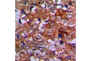 Immunohistochemical analysis of EPHA1 staining in human prostate cancer formalin fixed paraffin embedded tissue section. (EPHA1 antibody)