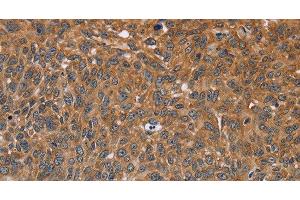 Immunohistochemistry of paraffin-embedded Human lung cancer using GH2 Polyclonal Antibody at dilution of 1:40 (Growth Hormone 2 antibody)