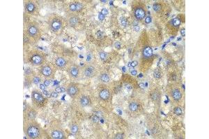 Immunohistochemistry of paraffin-embedded Human liver damage using TLK2 Polyclonal Antibody at dilution of 1:100 (40x lens).