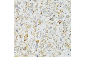 Immunohistochemistry of paraffin-embedded human lung cancer using DICER1 antibody (ABIN1877050) at dilution of 1:100 (40x lens). (DICER1 antibody)