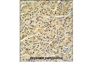 HOXA3 Antibody (C-term) (ABIN653846 and ABIN2843109) IHC analysis in formalin fixed and paraffin embedded prostate carcinoma followed by peroxidase conjugation of the secondary antibody and DAB staining. (HOXA3 antibody  (C-Term))