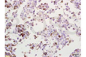 Formalin-fixed and paraffin embedded rat lung melanoma labeled with Anti-MAGE-1 Polyclonal Antibody, Unconjugated (ABIN728578) at 1:200, followed by conjugation to the secondary antibody and DAB staining (MAGEA1 antibody  (AA 101-200))