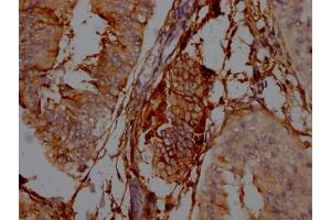 IHC image of ABIN7127408 diluted at 1:100 and staining in paraffin-embedded human endometrial cancer performed on a Leica BondTM system. (Recombinant CD73 antibody)