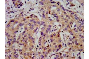 IHC image of ABIN7175596 diluted at 1:500 and staining in paraffin-embedded human liver cancer performed on a Leica BondTM system. (CACNB2 antibody  (AA 490-637))