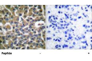 Immunohistochemical analysis of paraffin-embedded human breast carcinoma tissue using EEF2 polyclonal antibody . (EEF2 antibody  (Thr56))