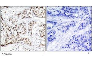 Immunohistochemical analysis of paraffin-embedded human breast carcinoma tissue using MAPK9/MAPK10 (phospho T183) polyclonal antibody . (JNK2 antibody  (pThr183))