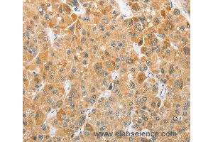 Immunohistochemistry of Human liver cancer using ATG5 Polyclonal Antibody at dilution of 1:40