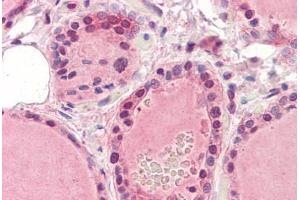 Human Thyroid (formalin-fixed, paraffin-embedded) stained with EPHA2 antibody ABIN364396 at 5 ug/ml followed by biotinylated anti-mouse IgG secondary antibody ABIN481714, alkaline phosphatase-streptavidin and chromogen. (EPH Receptor A2 antibody  (AA 559-976))