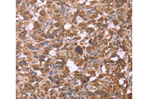 Immunohistochemistry of Human liver cancer using FBXW7 Polyclonal Antibody at dilution of 1:30 (FBXW7 antibody)