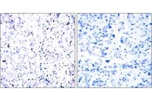 Immunohistochemistry analysis of paraffin-embedded human breast carcinoma tissue, using Retinoblastoma (Ab-807) Antibody. (Retinoblastoma Protein (Rb) antibody  (AA 781-830))
