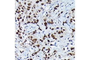 Immunohistochemistry of paraffin-embedded human breast cancer using C/EBPB Rabbit pAb (ABIN6134025, ABIN6138382, ABIN6138383 and ABIN6213964) at dilution of 1:100 (40x lens). (CEBPB antibody  (AA 150-250))