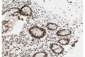ABIN6266629 at 1/100 staining human colon carcinoma tissue sections by IHC-P. (RCBTB1 antibody  (Internal Region))