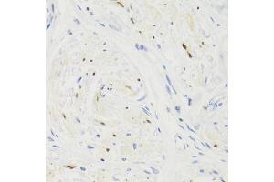 Immunohistochemistry of paraffin-embedded human breast cancer using GEMIN2 Antibody (ABIN1872798) at dilution of 1:100 (40x lens). (SIP1 antibody)