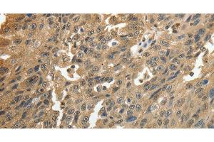 Immunohistochemistry of paraffin-embedded Human ovarian cancer using GSR Polyclonal Antibody at dilution of 1:50 (Glutathione Reductase antibody)