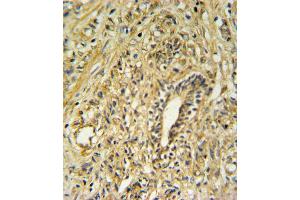 HSD17B2 Antibody IHC analysis in formalin fixed and paraffin embedded human prostate carcinoma followed by peroxidase conjugation of the secondary antibody and DAB staining. (HSD17B2 antibody  (AA 265-294))