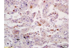 Formalin-fixed and paraffin embedded human lung carcinoma labeled with Anti-SDHB Polyclonal Antibody, Unconjugated (ABIN719411) at 1:200 followed by conjugation to the secondary antibody and DAB staining. (SDHB antibody  (AA 201-280))