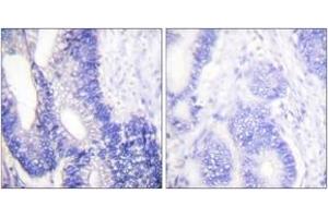 Immunohistochemistry analysis of paraffin-embedded human colon carcinoma tissue, using Claudin 3 Antibody.
