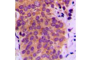 Immunohistochemical analysis of MKK4 (pS80) staining in human breast cancer formalin fixed paraffin embedded tissue section. (MAP2K4 antibody  (pSer80))