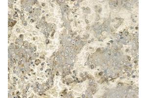 ABIN6261234 and ABIN6272285 at 1/100 staining human melanoma by IHC-P.