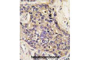 Formalin-fixed and paraffin-embedded human hepatocellular carcinoma reacted with HGF polyclonal antibody  , which was peroxidase-conjugated to the secondary antibody, followed by DAB staining. (HGF antibody  (AA 521-554))