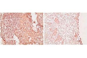 Immunohistochemistry analysis of human Breast tumor tissue stained with Estrogen receptor alpha monoclonal antibody (C-542), at 20 μg/mL. (Estrogen Receptor alpha antibody  (C-Term))