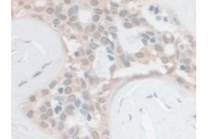 Detection of PCSK1 in Human Breast cancer Tissue using Polyclonal Antibody to Proprotein Convertase Subtilisin/Kexin Type 1 (PCSK1) (PCSK1 antibody  (AA 500-738))
