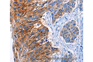 Immunohistochemistry of Human esophagus cancer using CLEC2B Polyclonal Antibody at dilution of 1:50