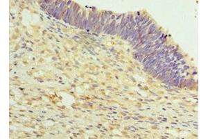 Immunohistochemistry of paraffin-embedded human ovarian cancer using ABIN7159637 at dilution of 1:100 (TET2 antibody  (AA 1833-2002))