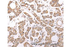Immunohistochemistry of Human breast cancer using ATPIF1 Polyclonal Antibody at dilution of 1:60 (ATPase Inhibitory Factor 1 antibody)