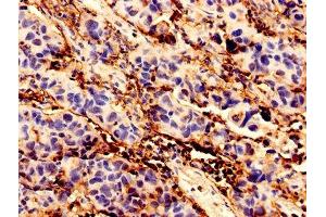 Immunohistochemistry analysis of human bladder cancer using ABIN7145741 at dilution of 1:100 (BCAT1 antibody  (AA 4-276))